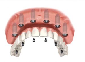 В каких случаях помогает технология реставрации зубов Al-4 и Al-6