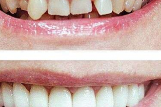 Что необходимо знать об эстетической реставрация зубов?