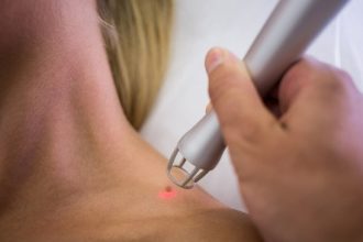 Удаление родинок у детей: особенности и безопасность